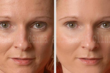 Anti Ageing Procedures – Wrinkles / Fine Lines Removal