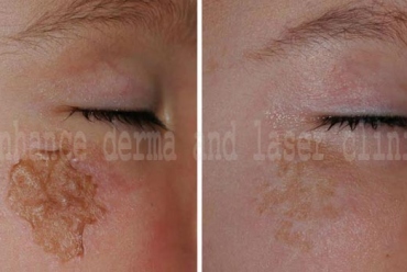 Pigment Removing Therapy – Freckles, Age spots, Blemishes, Nevus / Birth marks