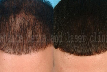 Scalp Hair Loss – Androgenetic Alopecia, Diffuse Hair Loss, Alopecia Areata